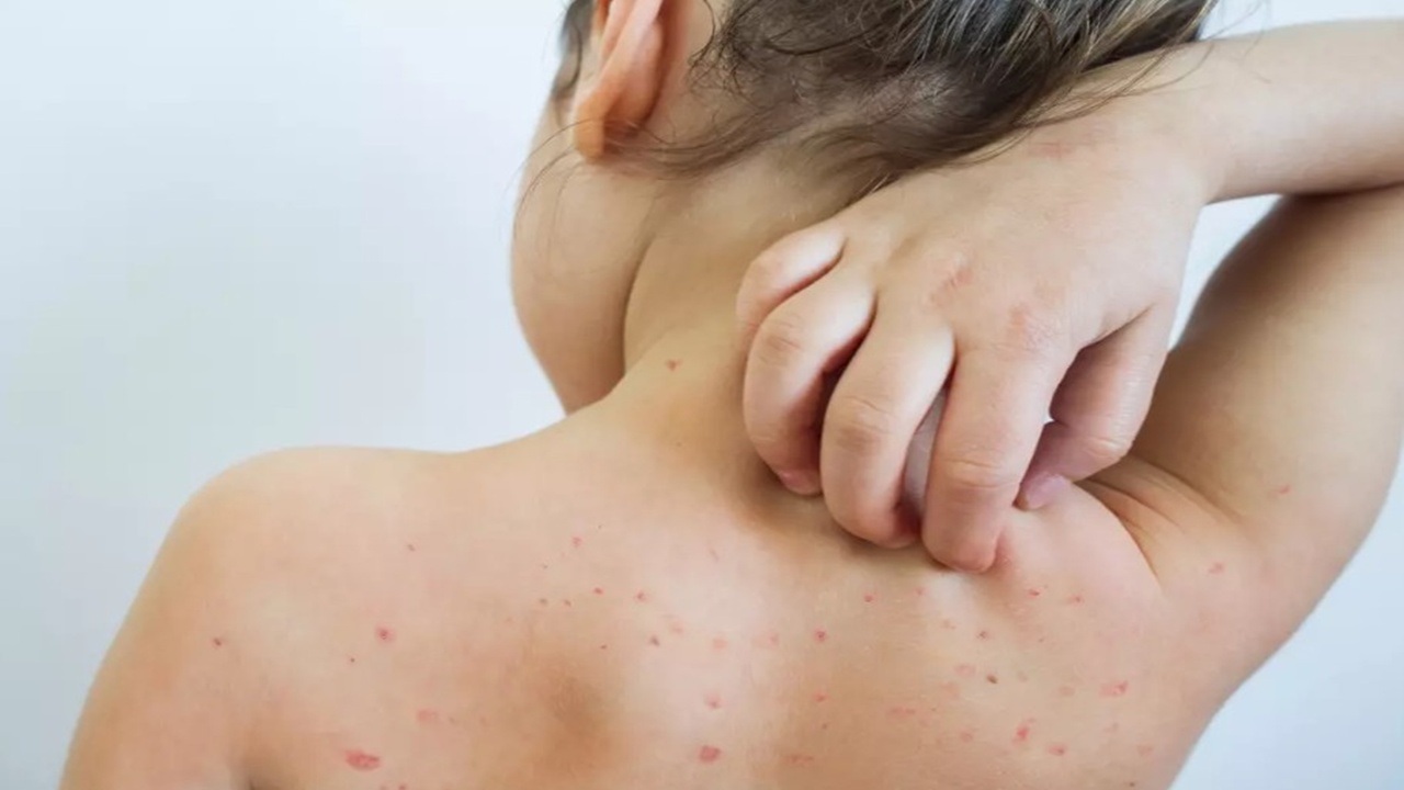 Polikliniklerde alarm! Uzman doktordan suçiçeği uyarısı: “İlk defa bu kadar sık görüyoruz”